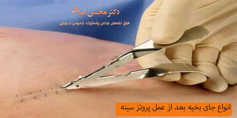 انواع-اسکار-و-جای-بخیه-بعد-از-عمل-پروتز-سینه