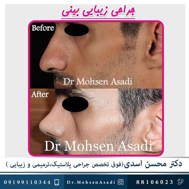 نمونه جراحی بینی مردانه دکتر محسن اسدی