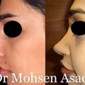 جراحی بینی استخوانی