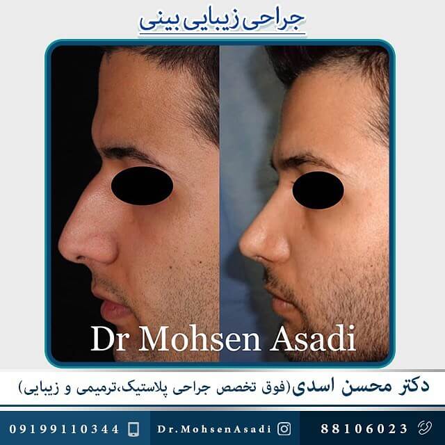 جراحی قوز بینی آقایان دکتر محسن اسدی