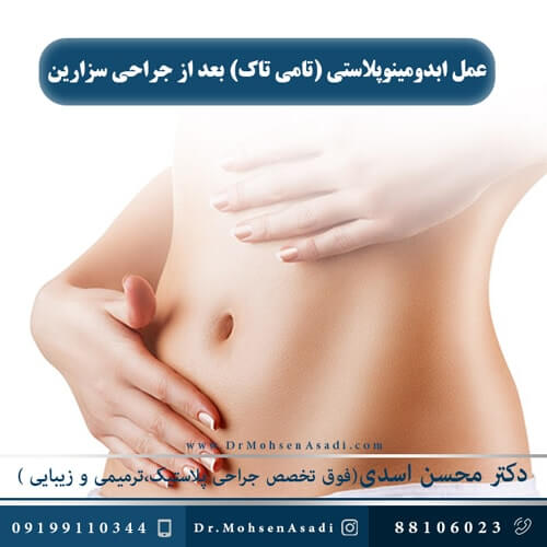 عمل ابدومینوپلاستی (تامی تاک) بعد از جراحی سزارین