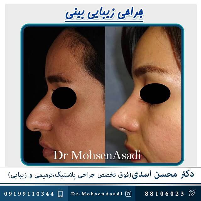 عمل بینی زیبایی توسط دکتر اسدی