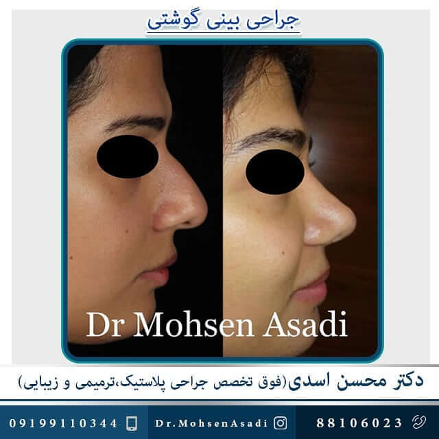 جراحی بینی دکتر اسدی با مدل طبیعی