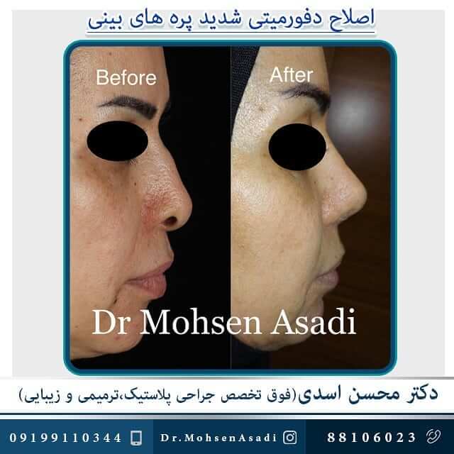 ترمیم بینی دکتر محسن اسدی