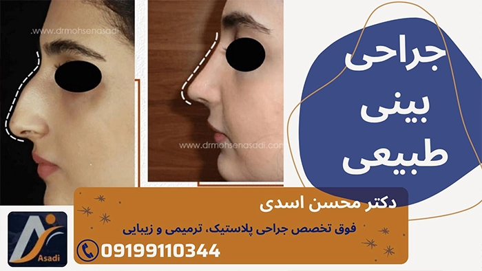 جراحی بینی طبیعی