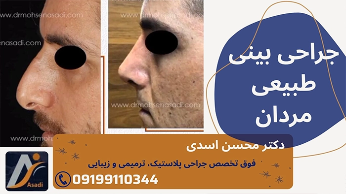 جراحی بینی طبیعی مردانه
