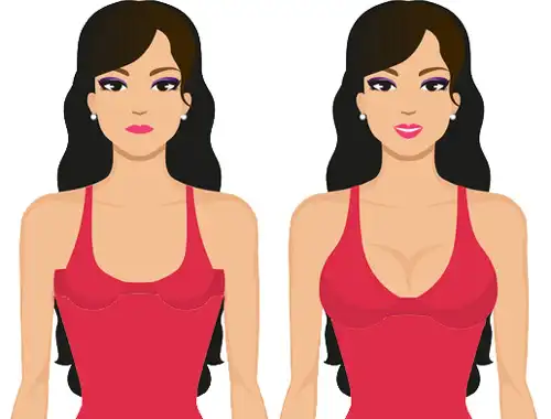 زیبایی پس از جراحی پروتز سینه