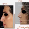 جراحی بینی طبیعی