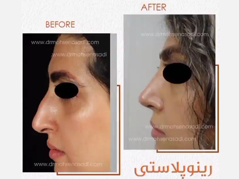 جراحی بینی طبیعی
