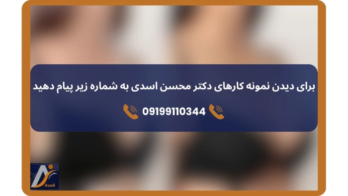 نمونه پروتز سینه