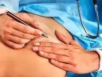 تعویض پروتز سینه