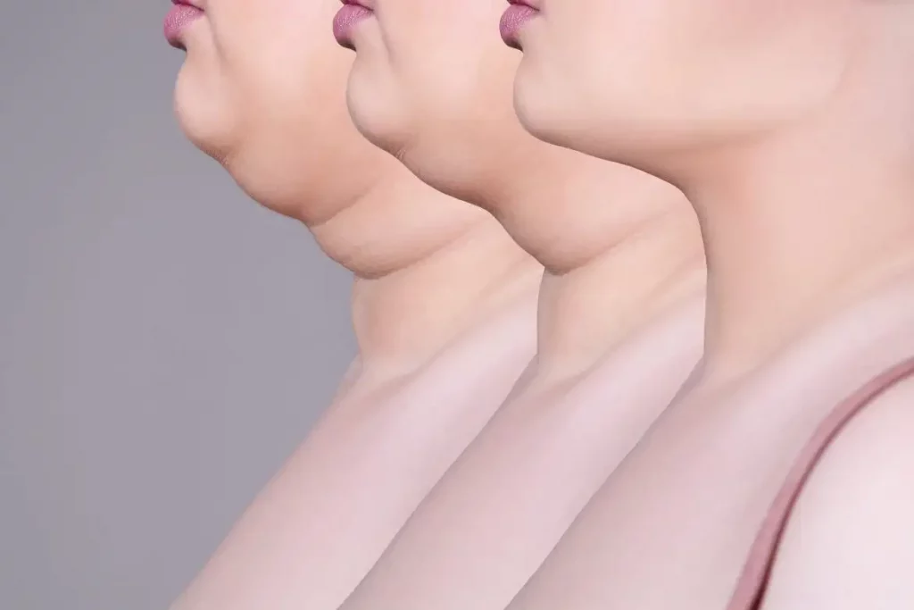 جراحی لیفت غبغب