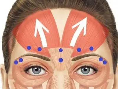 محل تزریق بوتاکس
