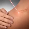 اسکار بعد از جراحی بینی
