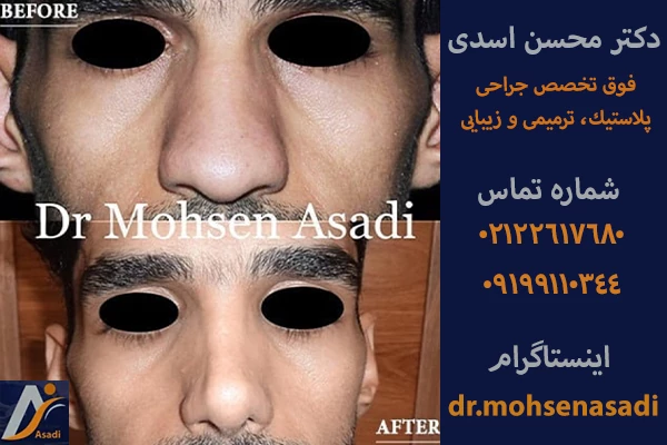 جراحی بینی گوشتی