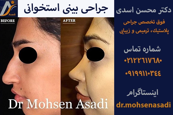 جراحی بینی استخوانی