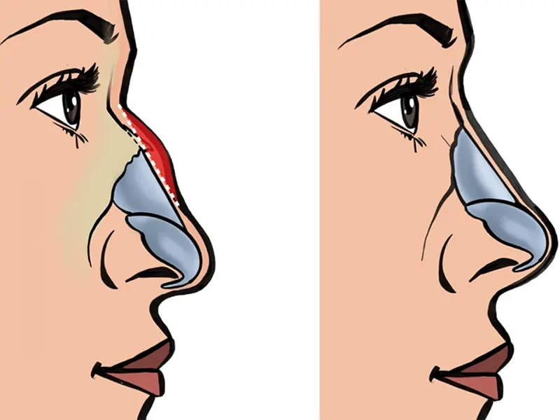 جراحی قوز بینی