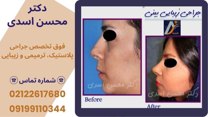 نمونه پیوند غضروف بینی