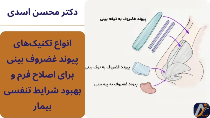 تکنیکهای پیوند غضروف به بینی