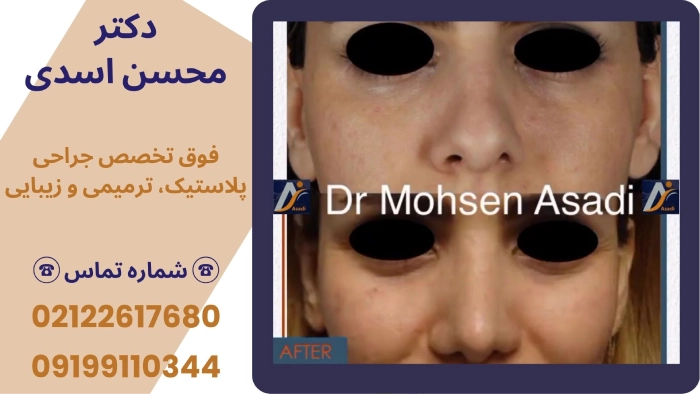 اصلاح نوک بینی