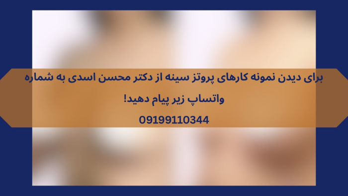 نمونه کار بهترین جراح پروتز سینه