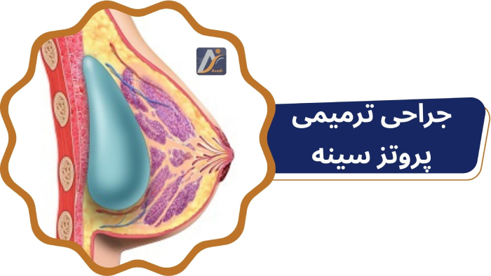 جراحی ترمیم پروتز سینه