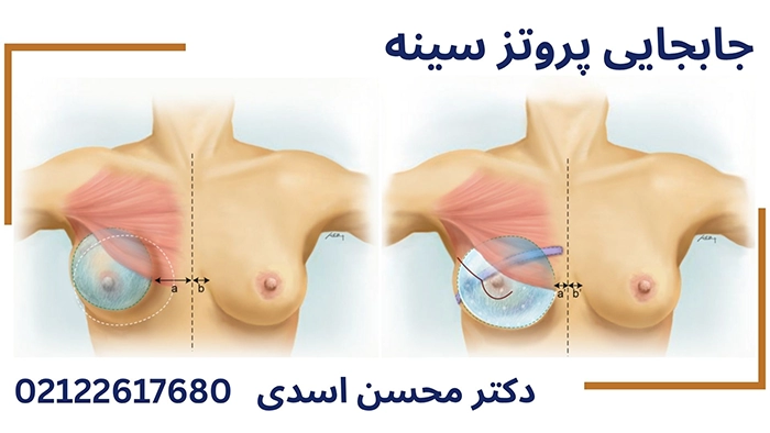 جابجایی پروتز سینه