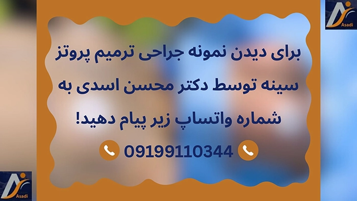 تفاوت پروتز سینه و لیفت