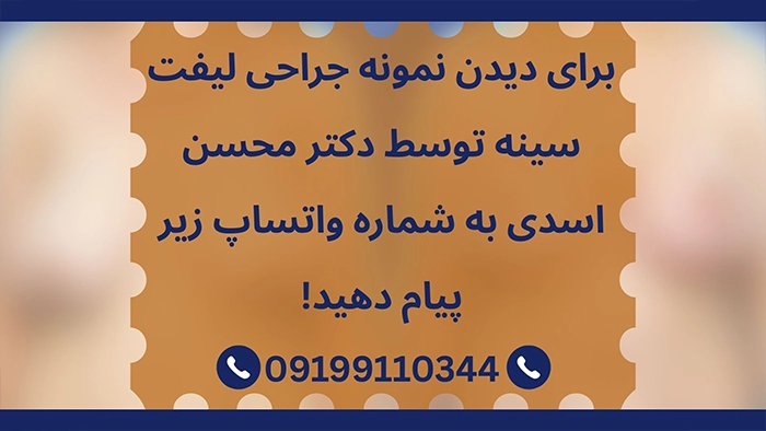لیفت یا پروتز سینه