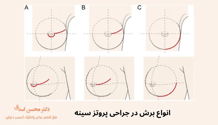 انواع برش در جراحی پروتز سینه