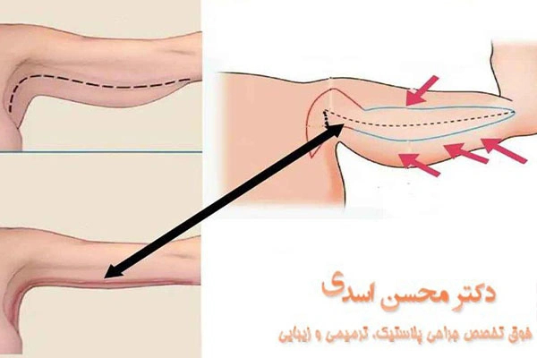 انجام لیفت بازو