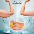 لیپوماتیک بازو ها